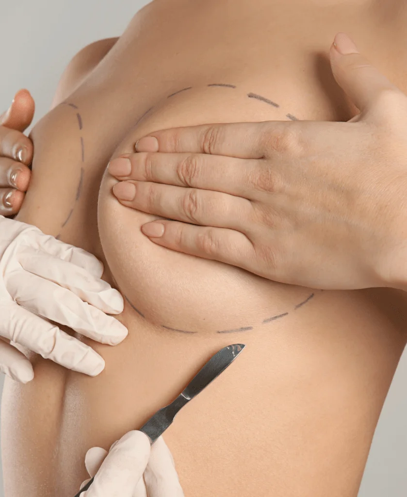 Breast Augmentation 839x1024 1
