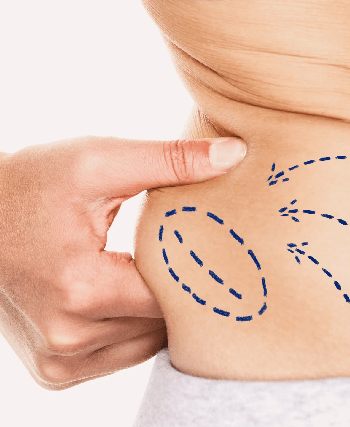 Liposuction 1