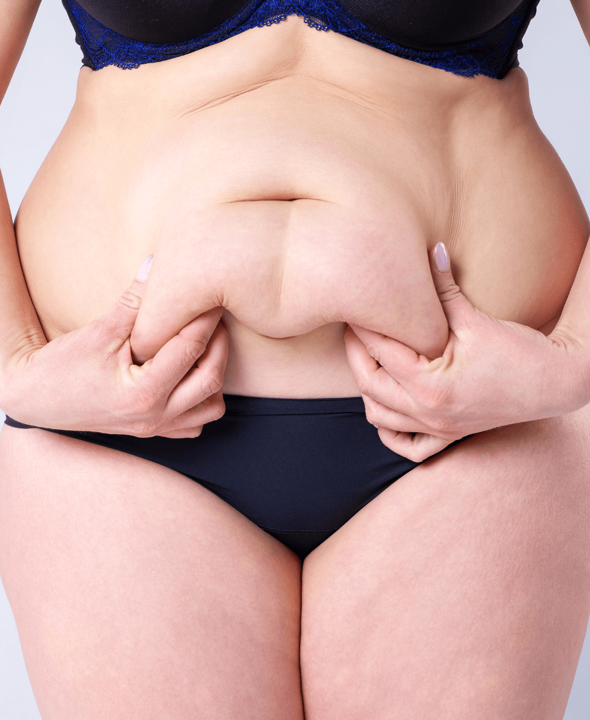 Tummy Tuck 1