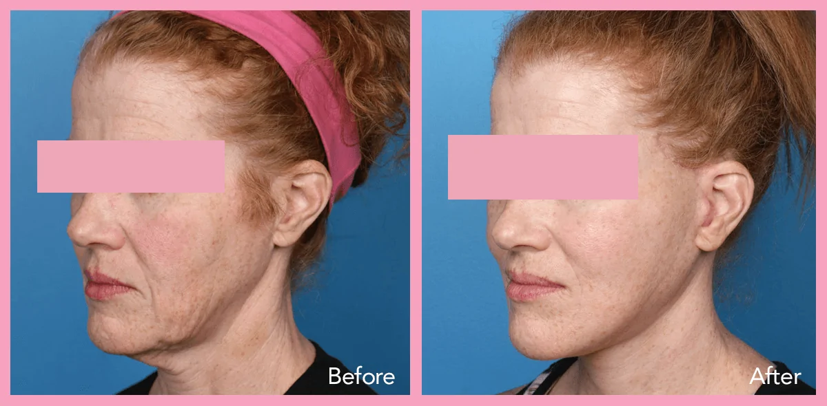 Face Lift