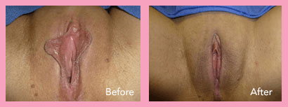 LABIAPLASTY 2