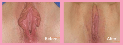 LABIAPLASTY 3