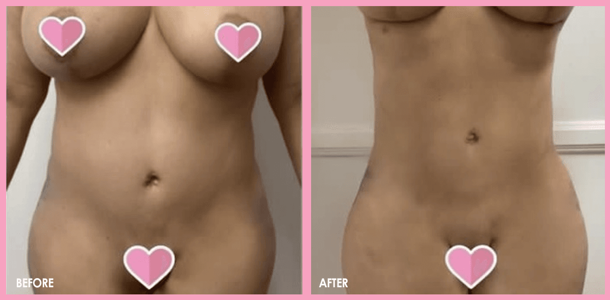Liposuction 1