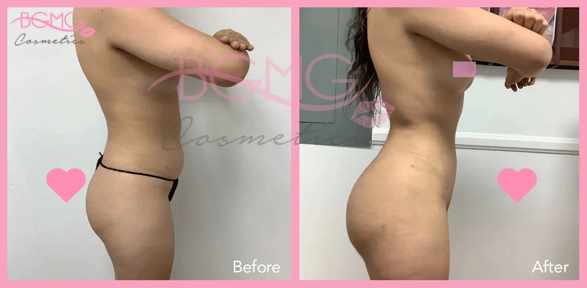Brazilian Butt Lift Treatment - BBL Surgery Before and After Results 03