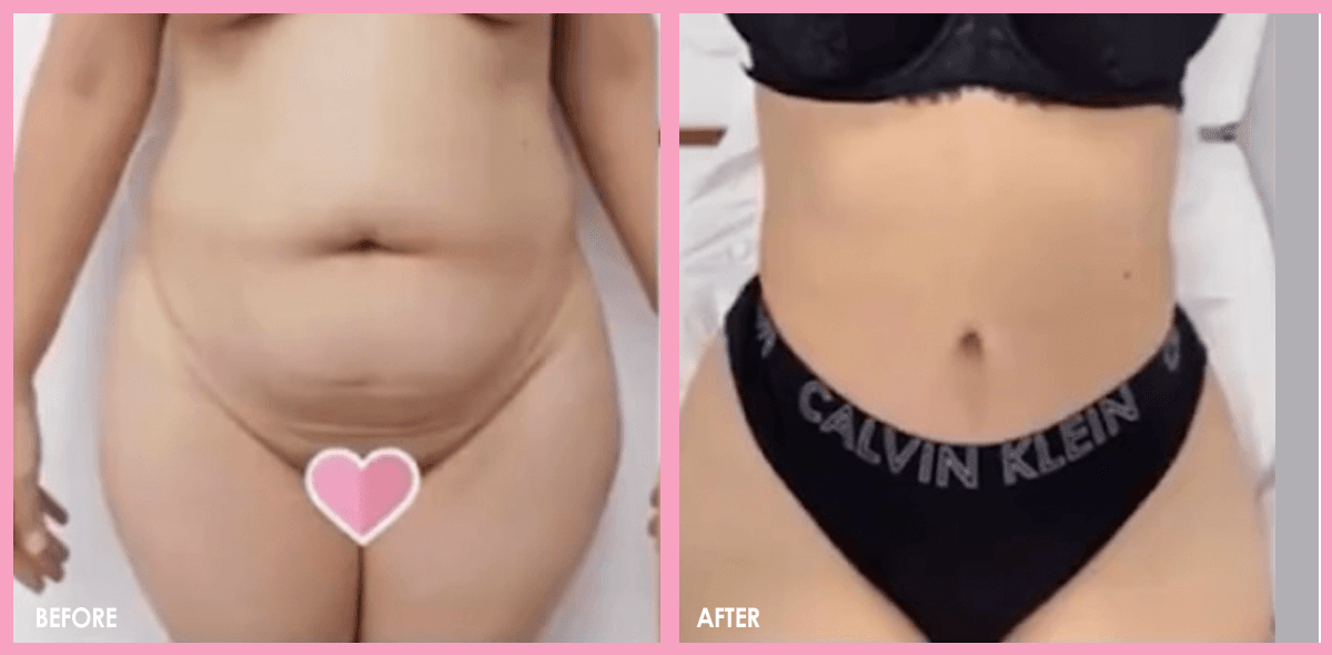 Tummy Tuck Surgery Before and After Results 02