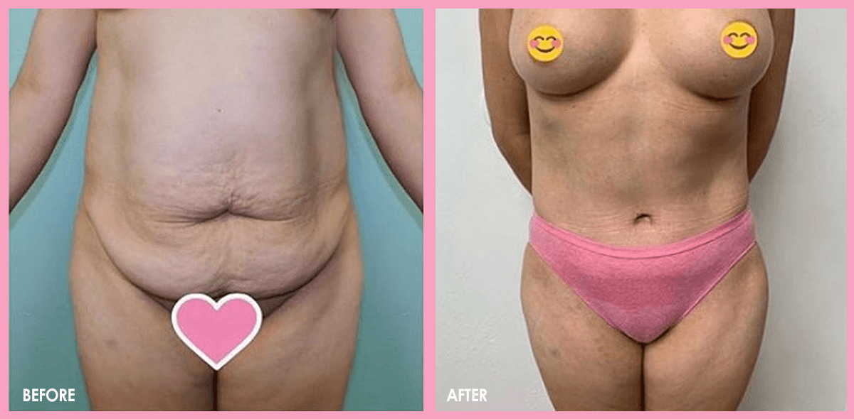 Tummy Tuck Surgery Before and After Results 03