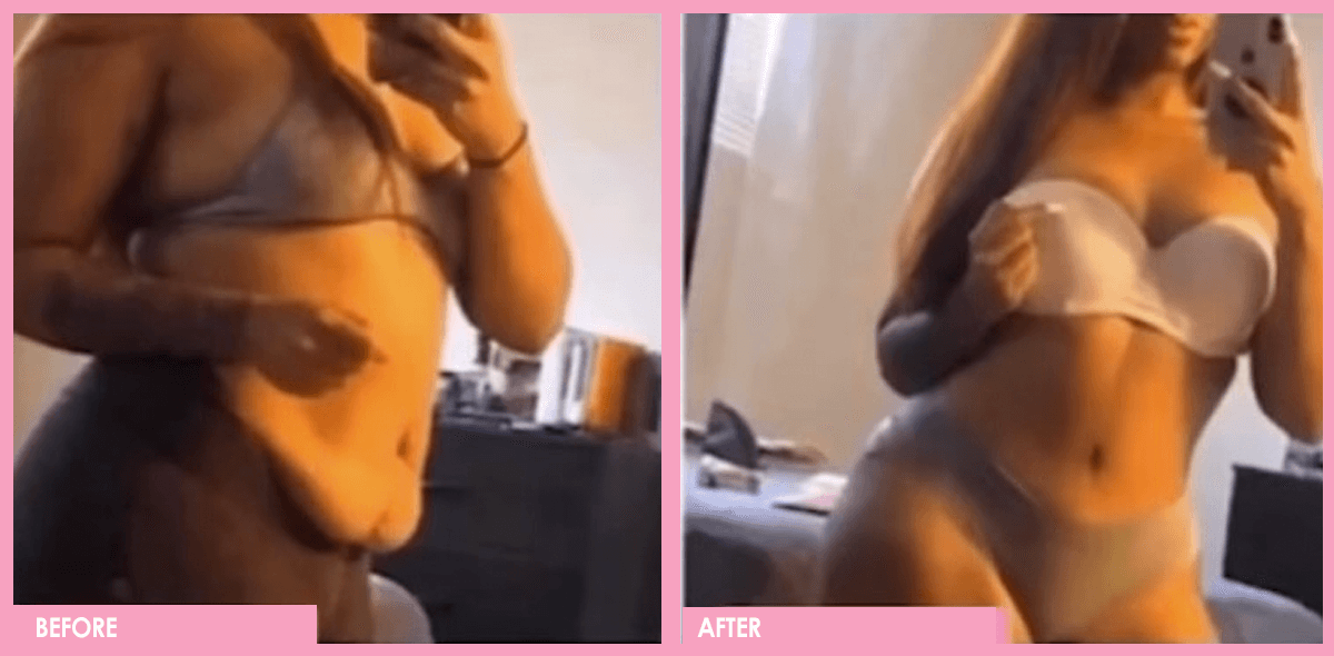 Tummy Tuck Surgery Before and After Results 01