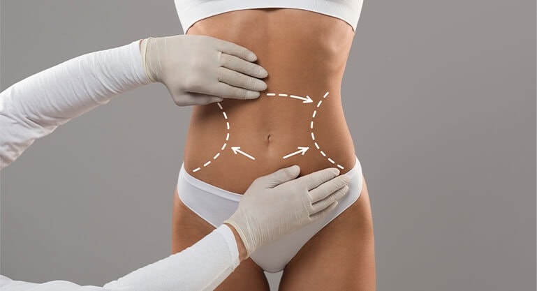 laser smartlipo liposuction in turkey