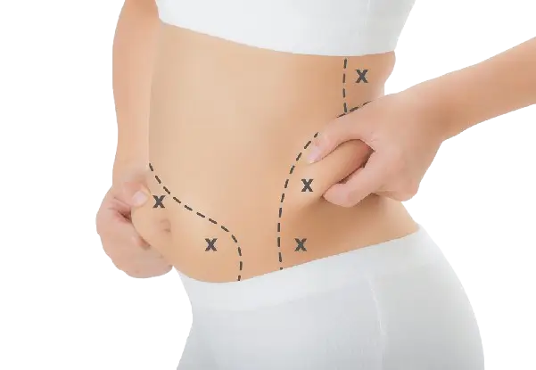arrows marking on a female body for showing how tummy tuck results will look like